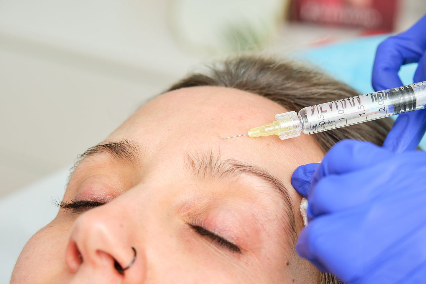 Tratamiento MESOTERAPIA FACIAL con Vitaminas + Radiofrecuencia