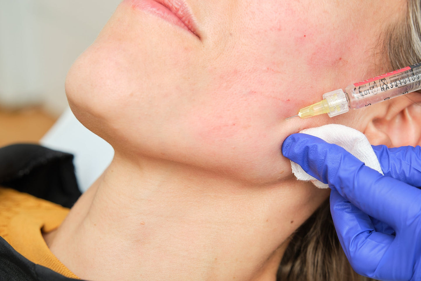 Tratamiento MESOTERAPIA FACIAL con Vitaminas + Radiofrecuencia